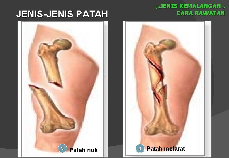 JENIS KEMALANGAN & CARA RAWATAN (5) JENIS-JENIS PATAH 3 Patah riuk 4 Patah melarat