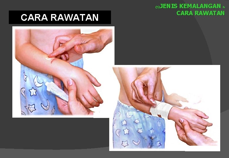 JENIS KEMALANGAN & CARA RAWATAN (5) CARA RAWATAN 