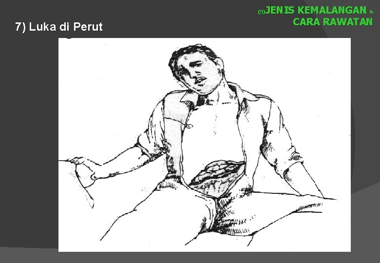 JENIS KEMALANGAN & CARA RAWATAN (5) 7) Luka di Perut 