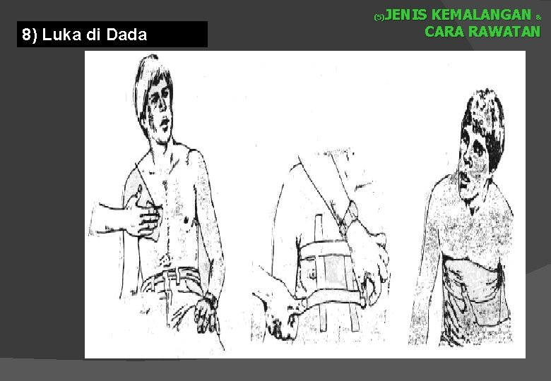 JENIS KEMALANGAN & CARA RAWATAN (5) 8) Luka di Dada 