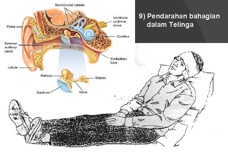 9) Pendarahan bahagian dalam Telinga 