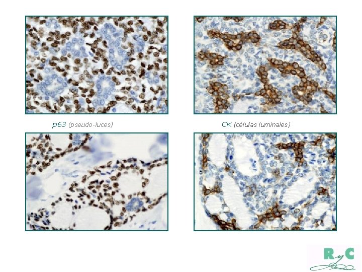 p 63 (pseudo-luces) CK (células luminales) 