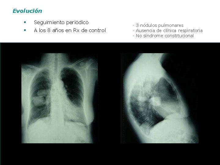 Evolución § § Seguimiento periódico A los 8 años en Rx de control §