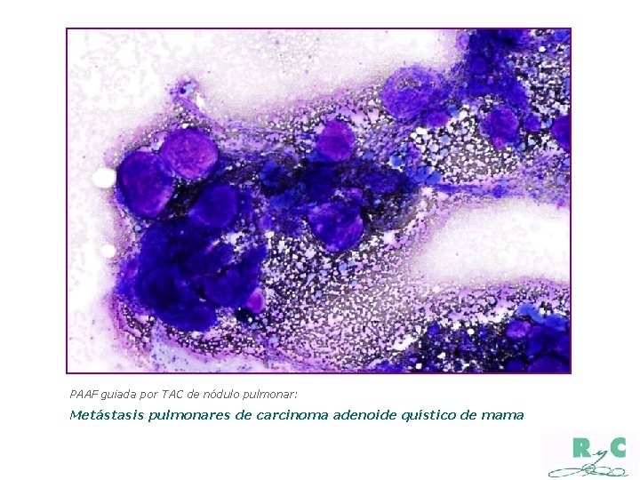 PAAF guiada por TAC de nódulo pulmonar: Metástasis pulmonares de carcinoma adenoide quístico de