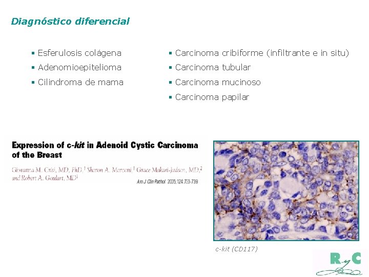 Diagnóstico diferencial § Esferulosis colágena § Carcinoma cribiforme (infiltrante e in situ) § Adenomioepitelioma