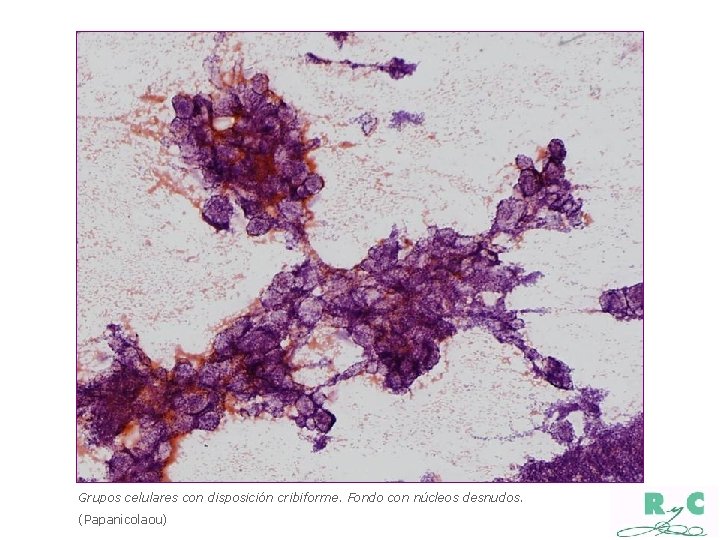 Grupos celulares con disposición cribiforme. Fondo con núcleos desnudos. (Papanicolaou) 