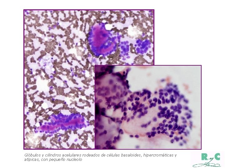 Glóbulos y cilindros acelulares rodeados de células basaloides, hipercromáticas y atípicas, con pequeño nucleolo