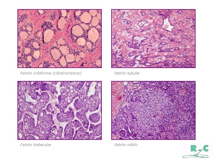 Patrón cribiforme (cilindromatoso) Patrón tubular Patrón trabecular Patrón sólido 