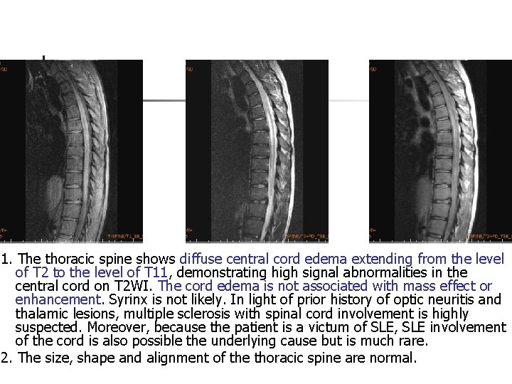 1. The thoracic spine shows diffuse central cord edema extending from the level of