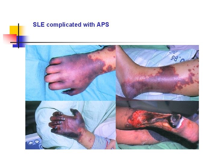 SLE complicated with APS 