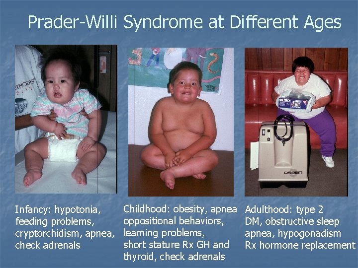 Prader-Willi Syndrome at Different Ages Infancy: hypotonia, feeding problems, cryptorchidism, apnea, check adrenals Childhood: