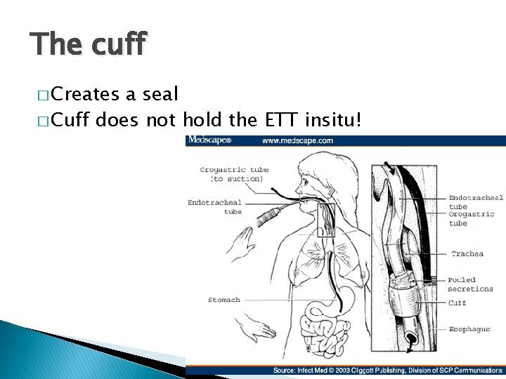 The cuff � Creates a seal � Cuff does not hold the ETT insitu!