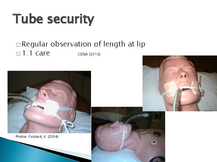 Tube security � Regular � 1: 1 care observation of length at lip Photos:
