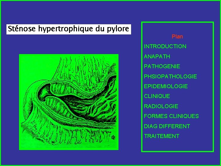 Sténose hypertrophique du pylore Plan INTRODUCTION ANAPATHOGENIE PHSIOPATHOLOGIE EPIDEMIOLOGIE CLINIQUE RADIOLOGIE FORMES CLINIQUES DIAG