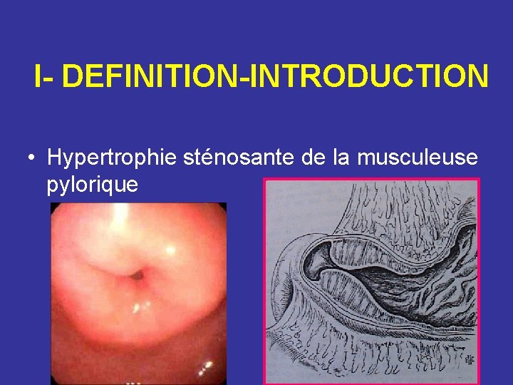 I- DEFINITION-INTRODUCTION • Hypertrophie sténosante de la musculeuse pylorique 