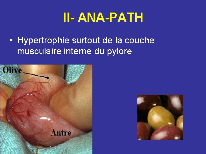 II- ANA-PATH • Hypertrophie surtout de la couche musculaire interne du pylore 