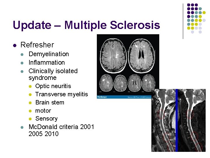 Update – Multiple Sclerosis l Refresher l l Demyelination Inflammation Clinically isolated syndrome l