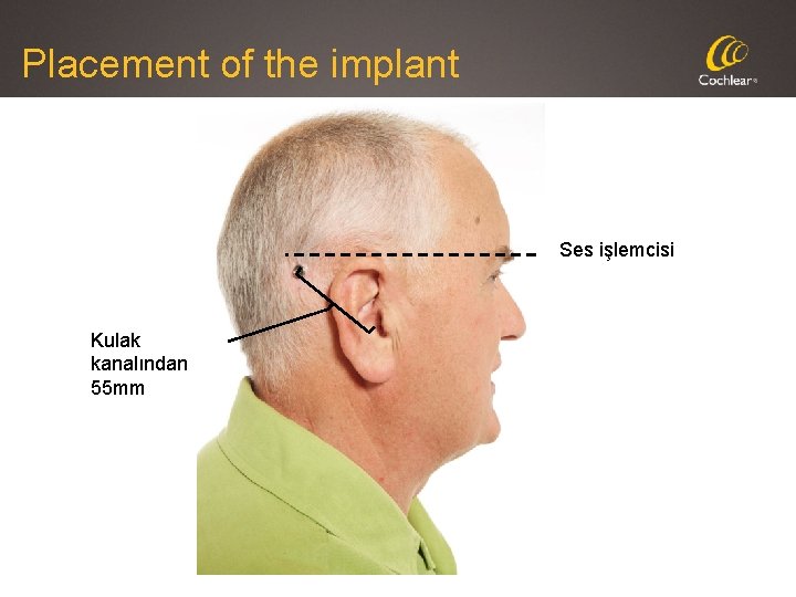 Placement of the implant Ses işlemcisi Kulak kanalından 55 mm 