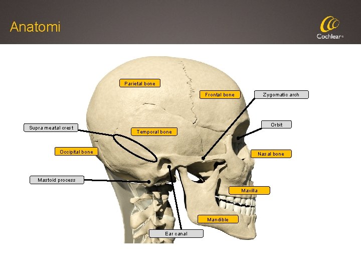 Anatomi Parietal bone Frontal bone Supra meatal crest Zygomatic arch Orbit Temporal bone Occipital