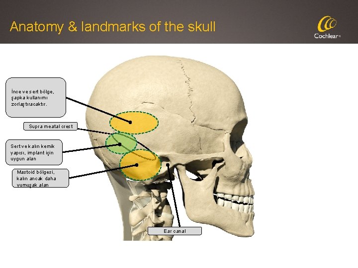 Anatomy & landmarks of the skull İnce ve sert bölge, şapka kullanımı zorlaştıracaktır. Supra