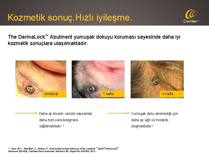 Kozmetik sonuç. Hızlı iyileşme. The Derma. Lock™ Abutment yumuşak dokuyu koruması sayesinde daha iyi