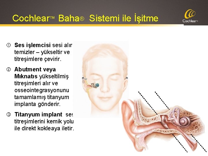 Cochlear™ Baha® Sistemi ile İşitme Ses işlemcisi sesi alır, temizler – yükseltir ve titreşimlere