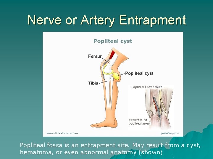 Nerve or Artery Entrapment Popliteal fossa is an entrapment site. May result from a