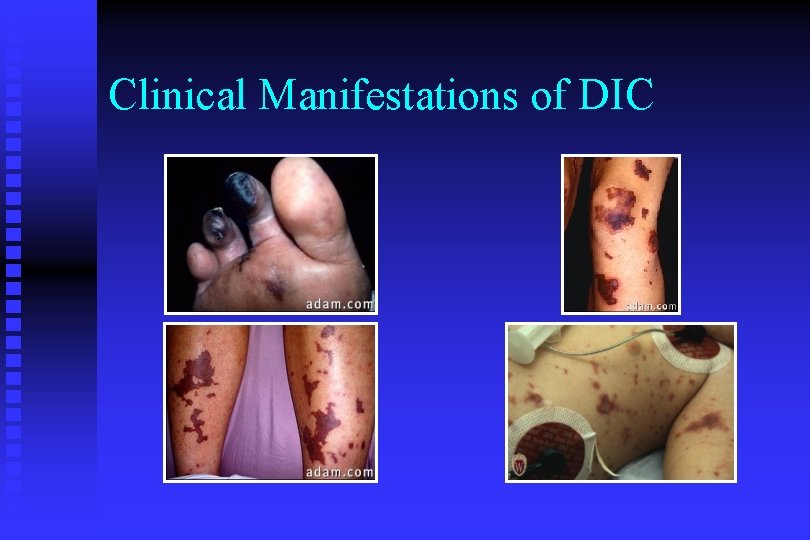 Clinical Manifestations of DIC 
