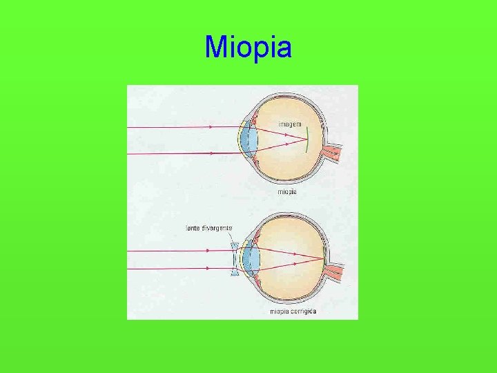 Miopia 