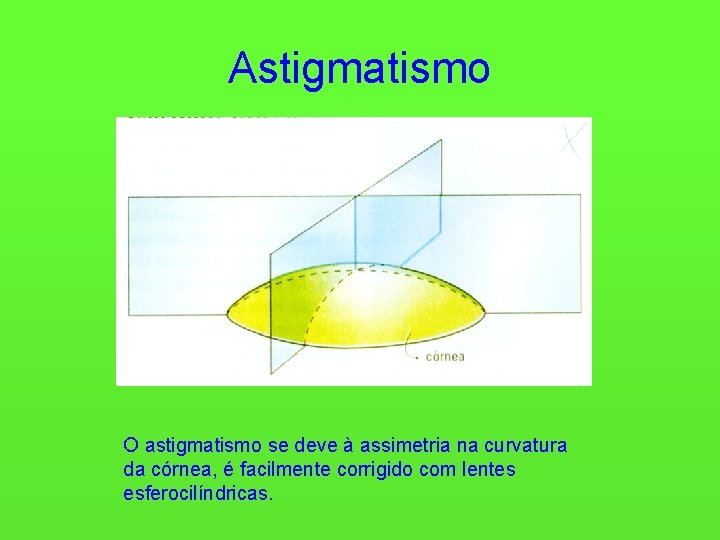 Astigmatismo O astigmatismo se deve à assimetria na curvatura da córnea, é facilmente corrigido
