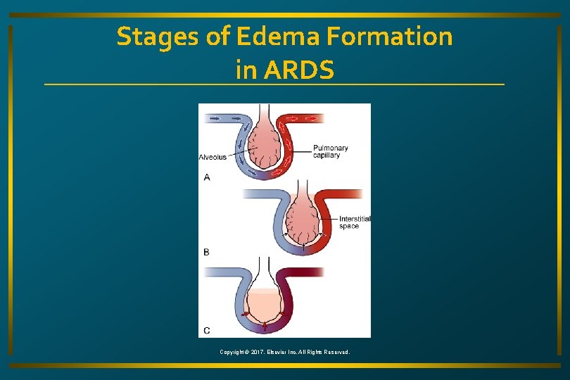 Stages of Edema Formation in ARDS Copyright © 2017, Elsevier Inc. All Rights Reserved.
