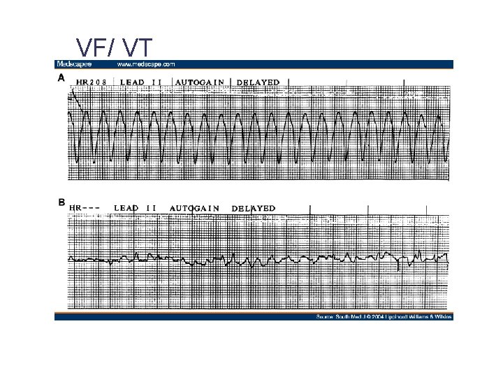 VF/ VT 