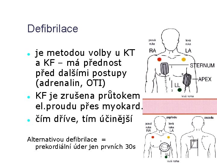 Defibrilace je metodou volby u KT a KF – má přednost před dalšími postupy