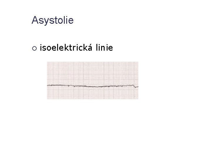 Asystolie isoelektrická linie 