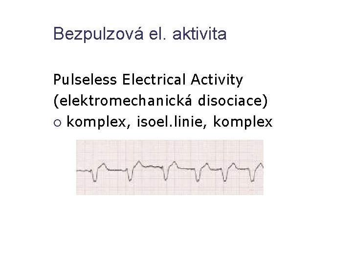 Bezpulzová el. aktivita Pulseless Electrical Activity (elektromechanická disociace) komplex, isoel. linie, komplex 