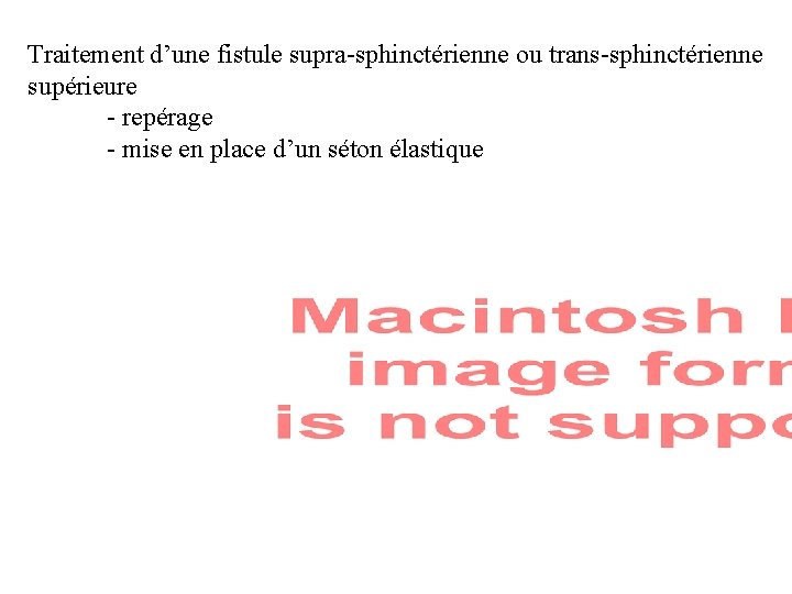 Traitement d’une fistule supra-sphinctérienne ou trans-sphinctérienne supérieure - repérage - mise en place d’un