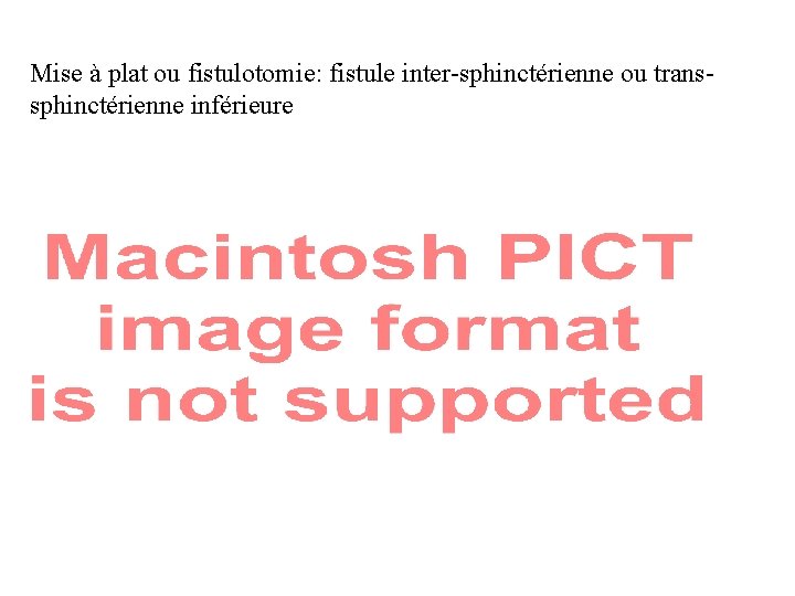 Mise à plat ou fistulotomie: fistule inter-sphinctérienne ou transsphinctérienne inférieure 