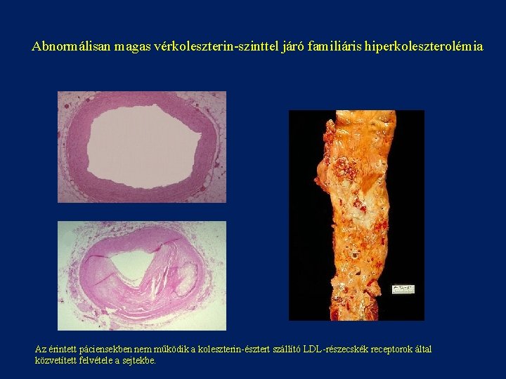 Abnormálisan magas vérkoleszterin-szinttel járó familiáris hiperkoleszterolémia Az érintett páciensekben nem működik a koleszterin-észtert szállító