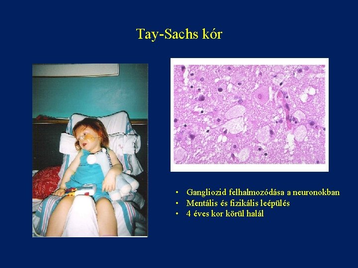 Tay-Sachs kór • Gangliozid felhalmozódása a neuronokban • Mentális és fizikális leépülés • 4