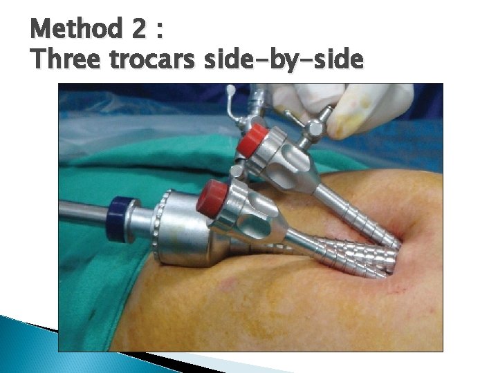 Method 2 : Three trocars side-by-side 