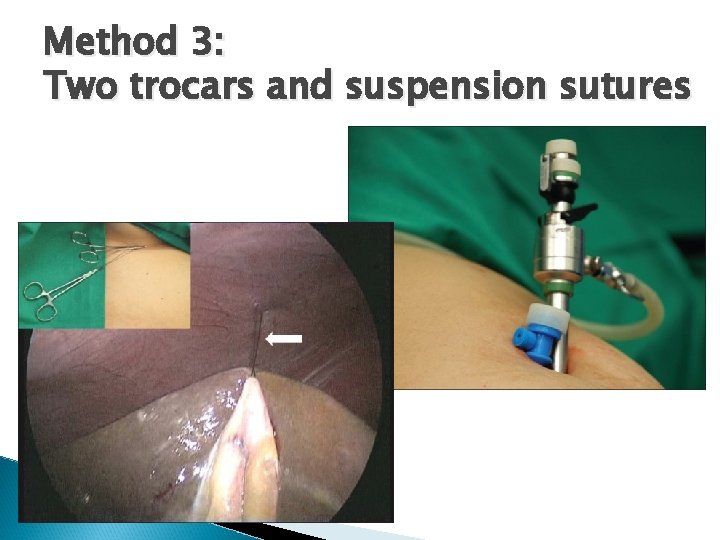 Method 3: Two trocars and suspension sutures 