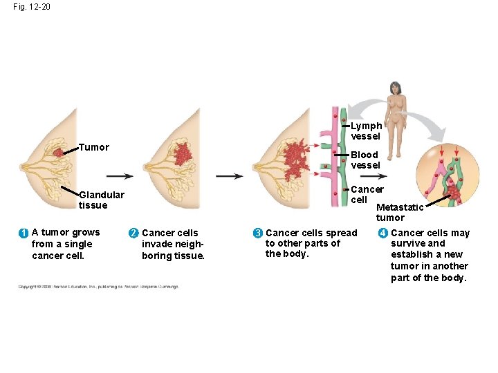 Fig. 12 -20 Lymph vessel Tumor Blood vessel Cancer cell Metastatic tumor Glandular tissue Fig. 12 -20 Lymph vessel Tumor Blood vessel Cancer cell Metastatic tumor Glandular tissue
