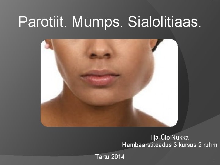 Parotiit. Mumps. Sialolitiaas. Ilja-Ülo Nukka Hambaarstiteadus 3 kursus 2 rühm Tartu 2014 1 