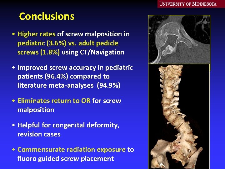 Conclusions • Higher rates of screw malposition in pediatric (3. 6%) vs. adult pedicle