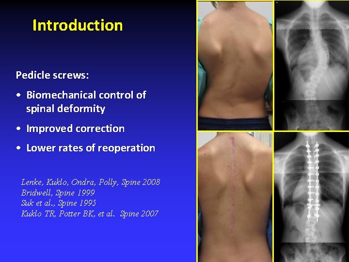 Introduction Pedicle screws: • Biomechanical control of spinal deformity • Improved correction • Lower