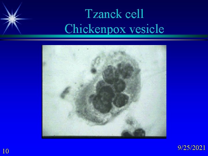 Tzanck cell Chickenpox vesicle 10 9/25/2021 