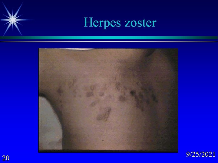 Herpes zoster 20 9/25/2021 