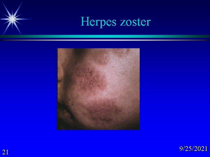 Herpes zoster 21 9/25/2021 