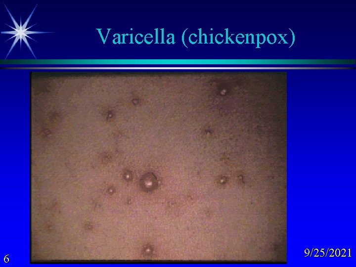 Varicella (chickenpox) 6 9/25/2021 