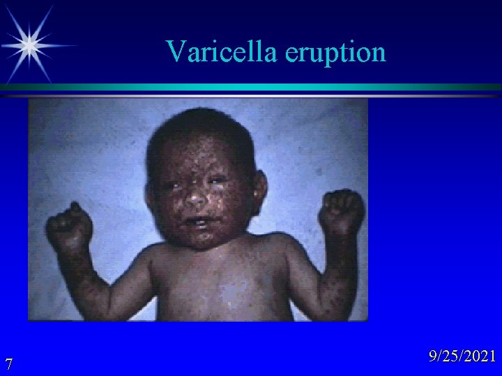 Varicella eruption 7 9/25/2021 